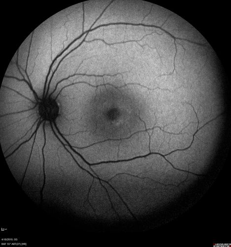 Central Serous Chorioretinopathy - Moderate
49 year old man with episodes in 2011, 2017, and 2018 - now with some paracentral vision loss in the right eye and subretinal fluid.
