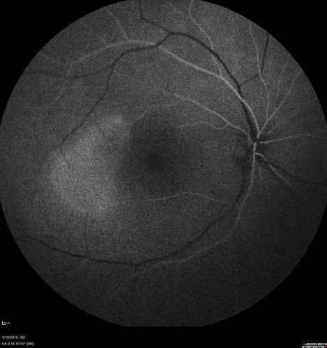 Central Serous Chorioretinopathy - Moderate
49 year old man with episodes in 2011, 2017, and 2018 - now with some paracentral vision loss in the right eye and subretinal fluid.

