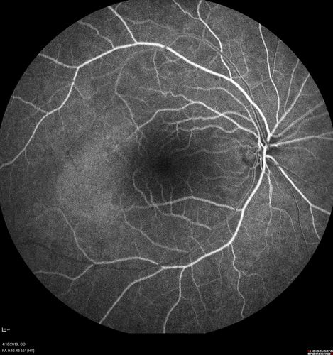 Central Serous Chorioretinopathy - Moderate
49 year old man with episodes in 2011, 2017, and 2018 - now with some paracentral vision loss in the right eye and subretinal fluid.
