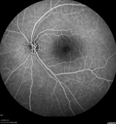 Central Serous Chorioretinopathy - Moderate
49 year old man with episodes in 2011, 2017, and 2018 - now with some paracentral vision loss in the right eye and subretinal fluid.
