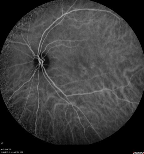 Central Serous Chorioretinopathy - Moderate
49 year old man with episodes in 2011, 2017, and 2018 - now with some paracentral vision loss in the right eye and subretinal fluid.
