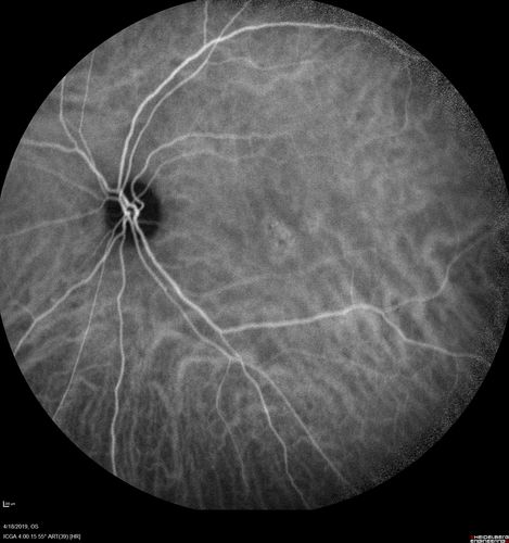 Central Serous Chorioretinopathy - Moderate
49 year old man with episodes in 2011, 2017, and 2018 - now with some paracentral vision loss in the right eye and subretinal fluid.
