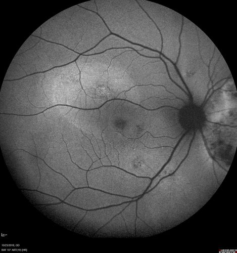 Chronic CSC Both Eyes - Recent vision loss Right Eye Treated with PDT
50 year old man The right eye has had vision loss for a few weeks.  He had previous episodes seen by me in 2012 OS and 2008 OD.  This was 2018. VA OS has been poor for several years.  
VA OD: Dcc20/100 
VA OS: Dcc20/200-3
The patient had PDT to leaky area superotemporal to the fovea 1/2 dose and within 3 months was back up to 20/25.  The last two OCT scans show fluid absorbing
