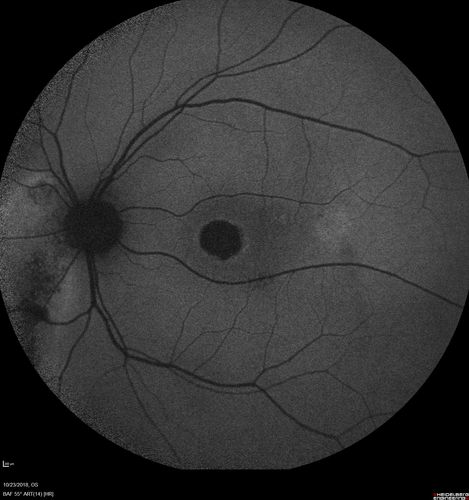 Chronic CSC Both Eyes - Recent vision loss Right Eye Treated with PDT
50 year old man The right eye has had vision loss for a few weeks.  He had previous episodes seen by me in 2012 OS and 2008 OD.  This was 2018. VA OS has been poor for several years.  
VA OD: Dcc20/100 
VA OS: Dcc20/200-3
The patient had PDT to leaky area superotemporal to the fovea 1/2 dose and within 3 months was back up to 20/25.  The last two OCT scans show fluid absorbing
