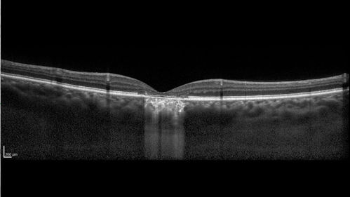 Chronic CSC Both Eyes - Recent vision loss Right Eye Treated with PDT
50 year old man The right eye has had vision loss for a few weeks.  He had previous episodes seen by me in 2012 OS and 2008 OD.  This was 2018. VA OS has been poor for several years.  
VA OD: Dcc20/100 
VA OS: Dcc20/200-3
The patient had PDT to leaky area superotemporal to the fovea 1/2 dose and within 3 months was back up to 20/25.  The last two OCT scans show fluid absorbing
