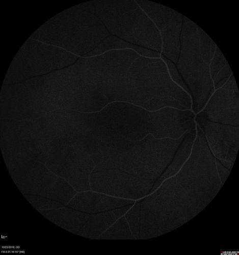 Chronic CSC Both Eyes - Recent vision loss Right Eye Treated with PDT
50 year old man The right eye has had vision loss for a few weeks.  He had previous episodes seen by me in 2012 OS and 2008 OD.  This was 2018. VA OS has been poor for several years.  
VA OD: Dcc20/100 
VA OS: Dcc20/200-3
The patient had PDT to leaky area superotemporal to the fovea 1/2 dose and within 3 months was back up to 20/25.  The last two OCT scans show fluid absorbing
