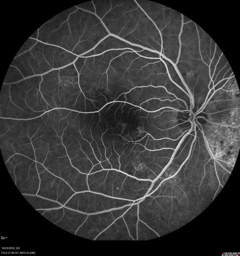 Chronic CSC Both Eyes - Recent vision loss Right Eye Treated with PDT
50 year old man The right eye has had vision loss for a few weeks.  He had previous episodes seen by me in 2012 OS and 2008 OD.  This was 2018. VA OS has been poor for several years.  
VA OD: Dcc20/100 
VA OS: Dcc20/200-3
The patient had PDT to leaky area superotemporal to the fovea 1/2 dose and within 3 months was back up to 20/25.  The last two OCT scans show fluid absorbing
