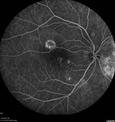 Chronic CSC Both Eyes - Recent vision loss Right Eye Treated with PDT
50 year old man The right eye has had vision loss for a few weeks.  He had previous episodes seen by me in 2012 OS and 2008 OD.  This was 2018. VA OS has been poor for several years.  
VA OD: Dcc20/100 
VA OS: Dcc20/200-3
The patient had PDT to leaky area superotemporal to the fovea 1/2 dose and within 3 months was back up to 20/25.  The last two OCT scans show fluid absorbing
