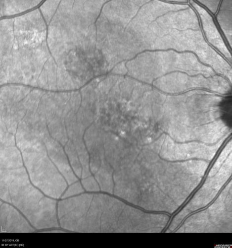 Chronic CSC Both Eyes - Recent vision loss Right Eye Treated with PDT
50 year old man The right eye has had vision loss for a few weeks.  He had previous episodes seen by me in 2012 OS and 2008 OD.  This was 2018. VA OS has been poor for several years.  
VA OD: Dcc20/100 
VA OS: Dcc20/200-3
The patient had PDT to leaky area superotemporal to the fovea 1/2 dose and within 3 months was back up to 20/25.  The last two OCT scans show fluid absorbing

