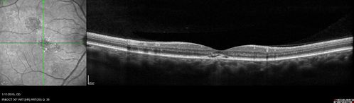 Chronic CSC Both Eyes - Recent vision loss Right Eye Treated with PDT
50 year old man The right eye has had vision loss for a few weeks.  He had previous episodes seen by me in 2012 OS and 2008 OD.  This was 2018. VA OS has been poor for several years.  
VA OD: Dcc20/100 
VA OS: Dcc20/200-3
The patient had PDT to leaky area superotemporal to the fovea 1/2 dose and within 3 months was back up to 20/25.  The last two OCT scans show fluid absorbing

