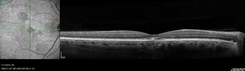 Chronic CSC Both Eyes - Recent vision loss Right Eye Treated with PDT
50 year old man The right eye has had vision loss for a few weeks.  He had previous episodes seen by me in 2012 OS and 2008 OD.  This was 2018. VA OS has been poor for several years.  
VA OD: Dcc20/100 
VA OS: Dcc20/200-3
The patient had PDT to leaky area superotemporal to the fovea 1/2 dose and within 3 months was back up to 20/25.  The last two OCT scans show fluid absorbing
