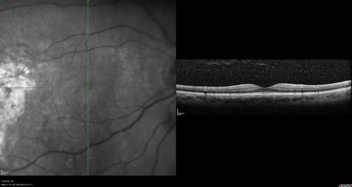 Normal Vision - Chronic Central Serous Chorioretinopathy
67 year old man - never had any symptoms - 20/16 vision in each eye.  Lesions spare the fovea
