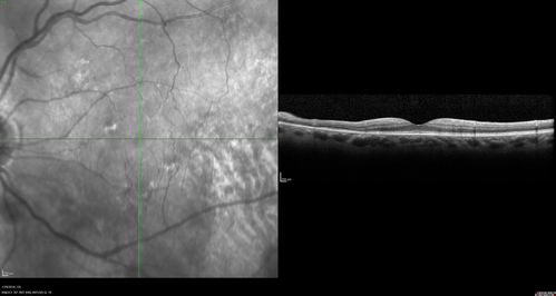Normal Vision - Chronic Central Serous Chorioretinopathy
67 year old man - never had any symptoms - 20/16 vision in each eye.  Lesions spare the fovea
