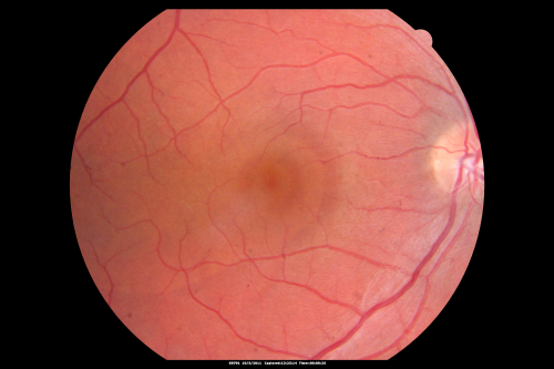 Central Serous Retinopathy Acute 
42-year-old man was seen in the office on October 5, 2011.  He had noticed starting in August after a course of antibiotic and steroids, that he developed new spots in his vision in the right eye.  He may have had an episode like this sometime in the past.  He did take steroids a few years ago and his vision did change at that time, but then returned.  

VISUAL ACUITY:  OD 20/32,  OS 20/32
