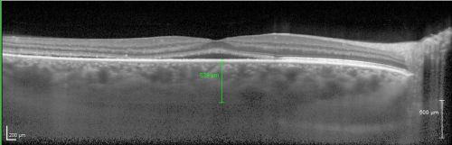 Central Serous Retinopathy Acute - Enhanced Depth Imaging OCT - Thickened Choriod
42-year-old man was seen in the office on October 5, 2011.  He had noticed starting in August after a course of antibiotic and steroids, that he developed new spots in his vision in the right eye.  He may have had an episode like this sometime in the past.  He did take steroids a few years ago and his vision did change at that time, but then returned.  

VISUAL ACUITY:  OD 20/32,  OS 20/32
