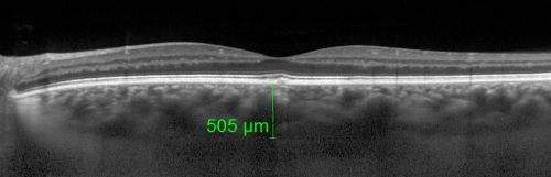 Central Serous Retinopathy Acute - Enhanced Depth Imaging OCT - Thickened Choriod
42-year-old man was seen in the office on October 5, 2011.  He had noticed starting in August after a course of antibiotic and steroids, that he developed new spots in his vision in the right eye.  He may have had an episode like this sometime in the past.  He did take steroids a few years ago and his vision did change at that time, but then returned.  

VISUAL ACUITY:  OD 20/32,  OS 20/32

