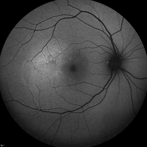 Central Serous Retinopathy Acute - Fundus Autofluorescence
42-year-old man was seen in the office on October 5, 2011.  He had noticed starting in August after a course of antibiotic and steroids, that he developed new spots in his vision in the right eye.  He may have had an episode like this sometime in the past.  He did take steroids a few years ago and his vision did change at that time, but then returned.  

VISUAL ACUITY:  OD 20/32,  OS 20/32
