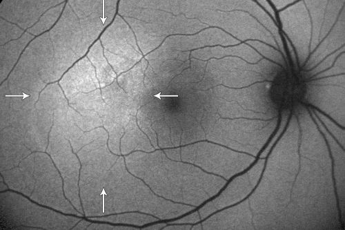 Central Serous Retinopathy Acute - Fundus Autofluorescence
42-year-old man was seen in the office on October 5, 2011.  He had noticed starting in August after a course of antibiotic and steroids, that he developed new spots in his vision in the right eye.  He may have had an episode like this sometime in the past.  He did take steroids a few years ago and his vision did change at that time, but then returned.  

VISUAL ACUITY:  OD 20/32,  OS 20/32
