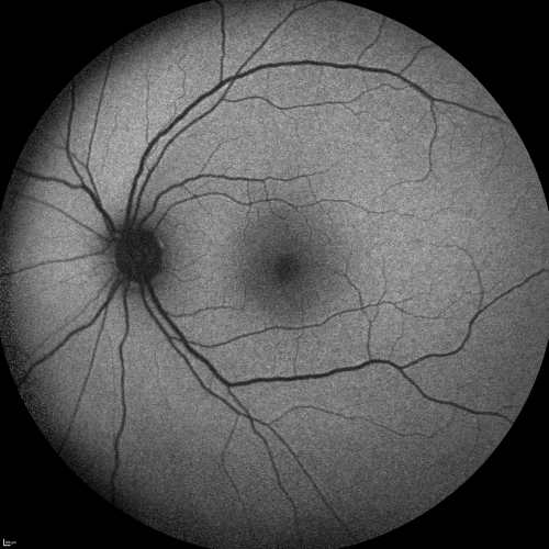 Central Serous Retinopathy Acute - Fundus Autofluorescence
42-year-old man was seen in the office on October 5, 2011.  He had noticed starting in August after a course of antibiotic and steroids, that he developed new spots in his vision in the right eye.  He may have had an episode like this sometime in the past.  He did take steroids a few years ago and his vision did change at that time, but then returned.  

VISUAL ACUITY:  OD 20/32,  OS 20/32
