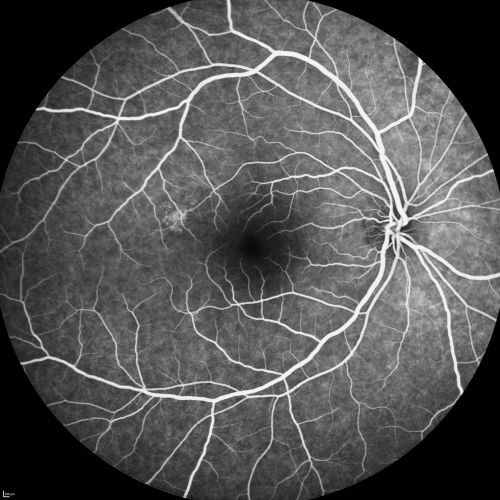Central Serous Retinopathy Acute - Fluorescein Angiogram
42-year-old man was seen in the office on October 5, 2011.  He had noticed starting in August after a course of antibiotic and steroids, that he developed new spots in his vision in the right eye.  He may have had an episode like this sometime in the past.  He did take steroids a few years ago and his vision did change at that time, but then returned.  

VISUAL ACUITY:  OD 20/32,  OS 20/32
