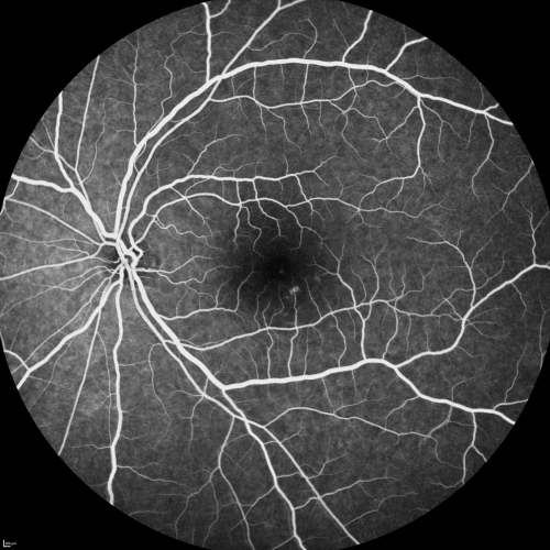 Central Serous Retinopathy Acute  - Fluorescein Angiogram
42-year-old man was seen in the office on October 5, 2011.  He had noticed starting in August after a course of antibiotic and steroids, that he developed new spots in his vision in the right eye.  He may have had an episode like this sometime in the past.  He did take steroids a few years ago and his vision did change at that time, but then returned.  

VISUAL ACUITY:  OD 20/32,  OS 20/32
