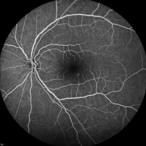 Central Serous Retinopathy Acute  - Fluorescein Angiogram
42-year-old man was seen in the office on October 5, 2011.  He had noticed starting in August after a course of antibiotic and steroids, that he developed new spots in his vision in the right eye.  He may have had an episode like this sometime in the past.  He did take steroids a few years ago and his vision did change at that time, but then returned.  

VISUAL ACUITY:  OD 20/32,  OS 20/32
