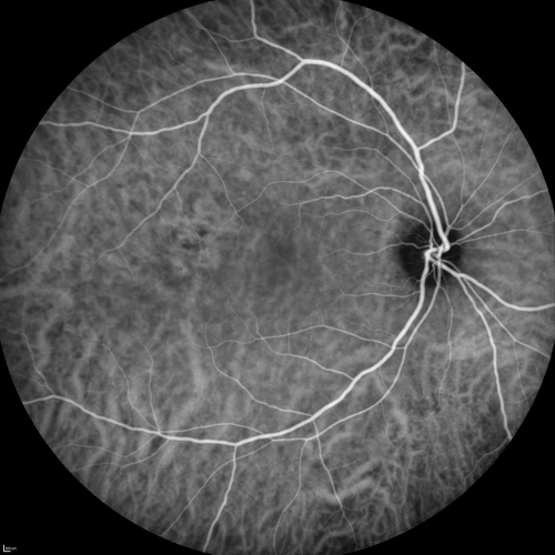 Central Serous Retinopathy Acute - Indocyanine Green Angiogram - Leakage Choriocapillaris 
42-year-old man was seen in the office on October 5, 2011.  He had noticed starting in August after a course of antibiotic and steroids, that he developed new spots in his vision in the right eye.  He may have had an episode like this sometime in the past.  He did take steroids a few years ago and his vision did change at that time, but then returned.  

VISUAL ACUITY:  OD 20/32,  OS 20/32
