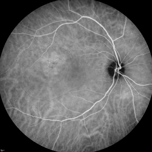 Central Serous Retinopathy Acute - Indocyanine Green Angiogram - Leakage Choriocapillaris 
42-year-old man was seen in the office on October 5, 2011.  He had noticed starting in August after a course of antibiotic and steroids, that he developed new spots in his vision in the right eye.  He may have had an episode like this sometime in the past.  He did take steroids a few years ago and his vision did change at that time, but then returned.  

VISUAL ACUITY:  OD 20/32,  OS 20/32
