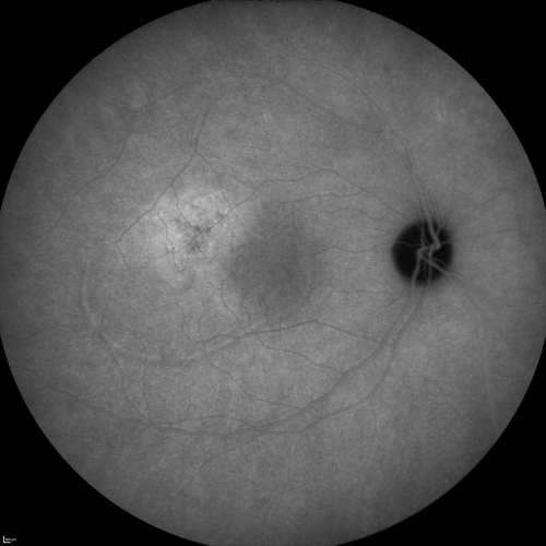 Central Serous Retinopathy Acute - Indocyanine Green Angiogram - Leakage Choriocapillaris 
42-year-old man was seen in the office on October 5, 2011.  He had noticed starting in August after a course of antibiotic and steroids, that he developed new spots in his vision in the right eye.  He may have had an episode like this sometime in the past.  He did take steroids a few years ago and his vision did change at that time, but then returned.  

VISUAL ACUITY:  OD 20/32,  OS 20/32
