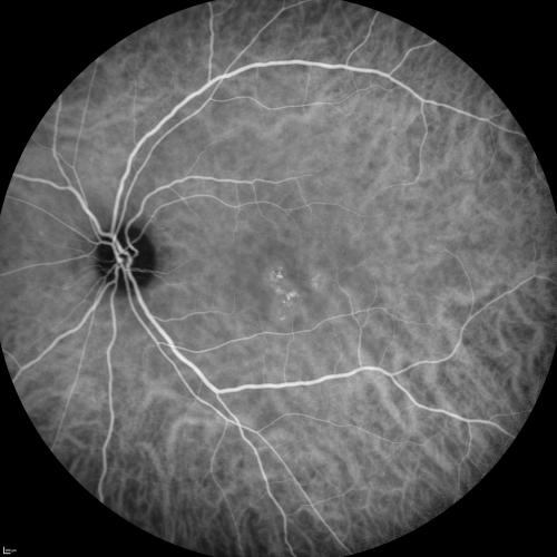Central Serous Retinopathy Acute - Indocyanine Green Angiogram - Leakage Choriocapillaris 
42-year-old man was seen in the office on October 5, 2011.  He had noticed starting in August after a course of antibiotic and steroids, that he developed new spots in his vision in the right eye.  He may have had an episode like this sometime in the past.  He did take steroids a few years ago and his vision did change at that time, but then returned.  

VISUAL ACUITY:  OD 20/32,  OS 20/32
