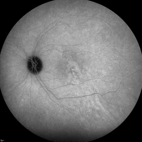 Central Serous Retinopathy Acute - Indocyanine Green Angiogram - Leakage Choriocapillaris 
42-year-old man was seen in the office on October 5, 2011.  He had noticed starting in August after a course of antibiotic and steroids, that he developed new spots in his vision in the right eye.  He may have had an episode like this sometime in the past.  He did take steroids a few years ago and his vision did change at that time, but then returned.  

VISUAL ACUITY:  OD 20/32,  OS 20/32
