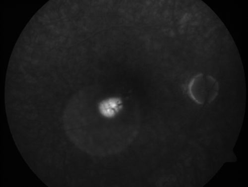 Central Serous Retinopathy - Acute
49-year-old man sees a spot in the central vision with a red halo for 2 weeks OD is 20/50, OS is 20/20
Keywords: csr;central serous retinopathy;ped