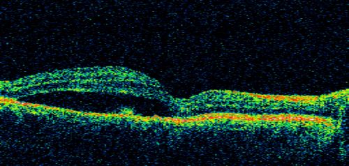 Central Serous Retinopathy - Acute
49-year-old man sees a spot in the central vision with a red halo for 2 weeks OD is 20/50, OS is 20/20
Schlüsselwörter: csr;central serous retinopathy;ped