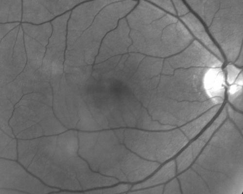 Central Serous Retinopathy - Acute
49-year-old man sees a spot in the central vision with a red halo for 2 weeks OD is 20/50, OS is 20/20
Võtmesõnad: csr;central serous retinopathy;ped