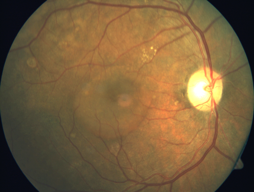 Multifocal Bilateral Central Serous Retinopathy in African American Male
67 year old african american male with : Blurred Vision OD. Duration of Problem: 4-6 weeks. VA 20/32 OD 20/20 OS
