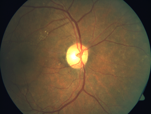 Multifocal Bilateral Central Serous Retinopathy in African American Male
67 year old african american male with : Blurred Vision OD. Duration of Problem: 4-6 weeks. VA 20/32 OD 20/20 OS
