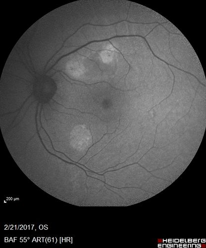 Multifocal Bilateral Central Serous Retinopathy in African American Male
67 year old african american male with : Blurred Vision OD. Duration of Problem: 4-6 weeks. VA 20/32 OD 20/20 OS
