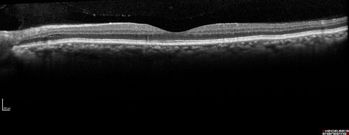 Multifocal Bilateral Central Serous Retinopathy in African American Male
67 year old african american male with : Blurred Vision OD. Duration of Problem: 4-6 weeks. VA 20/32 OD 20/20 OS
