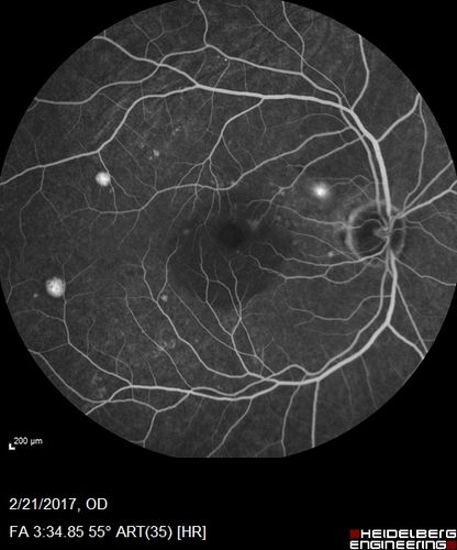 Multifocal Bilateral Central Serous Retinopathy in African American Male
67 year old african american male with : Blurred Vision OD. Duration of Problem: 4-6 weeks. VA 20/32 OD 20/20 OS
