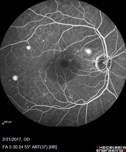 Multifocal Bilateral Central Serous Retinopathy in African American Male
67 year old african american male with : Blurred Vision OD. Duration of Problem: 4-6 weeks. VA 20/32 OD 20/20 OS
