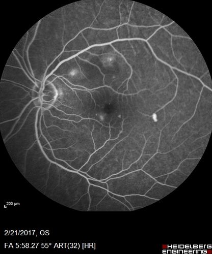 Multifocal Bilateral Central Serous Retinopathy in African American Male
67 year old african american male with : Blurred Vision OD. Duration of Problem: 4-6 weeks. VA 20/32 OD 20/20 OS
