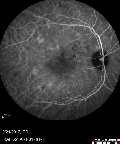 Multifocal Bilateral Central Serous Retinopathy in African American Male
67 year old african american male with : Blurred Vision OD. Duration of Problem: 4-6 weeks. VA 20/32 OD 20/20 OS
