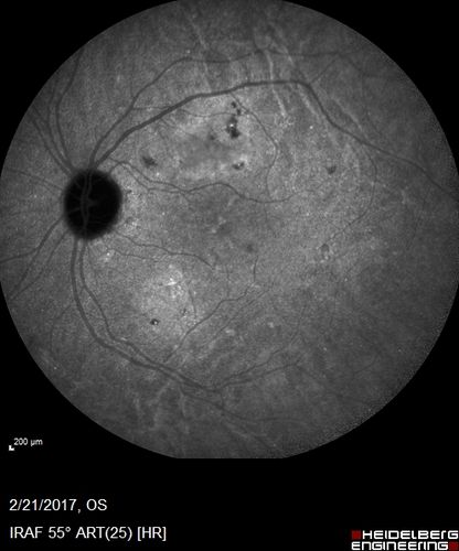 Multifocal Bilateral Central Serous Retinopathy in African American Male
67 year old african american male with : Blurred Vision OD. Duration of Problem: 4-6 weeks. VA 20/32 OD 20/20 OS

