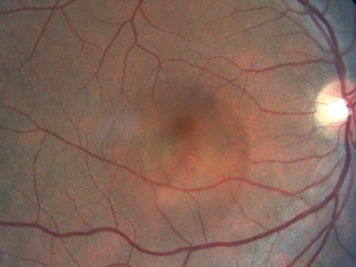 Acute Central Serous Retinopathy (Chorioretinopathy) Right Eye
45-year-old man decreased vision in the right eye starting about two days ago.  VISUAL ACUITY:  Vision OD is 20/60, OS is 20/20.  
