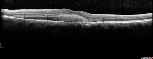 Central Serous Retinopathy - Subretinal Fibrin
66 year old female with 20 year history of single episode of CSR.  Now with vision loss for a month but improving - VA 20/63 OD; 20/32 OS
