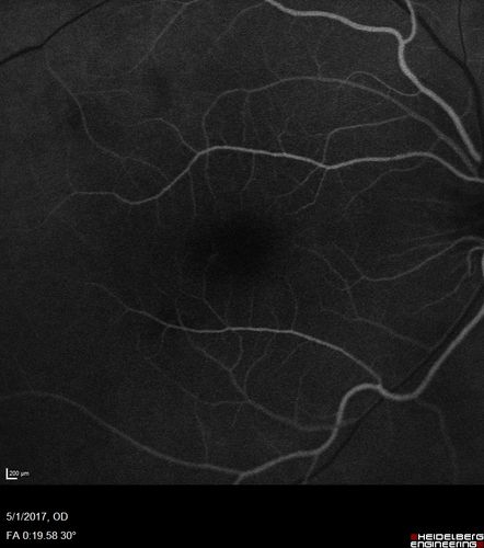 Central Serous Retinopathy - Subretinal Fibrin
66 year old female with 20 year history of single episode of CSR.  Now with vision loss for a month but improving - VA 20/63 OD; 20/32 OS
