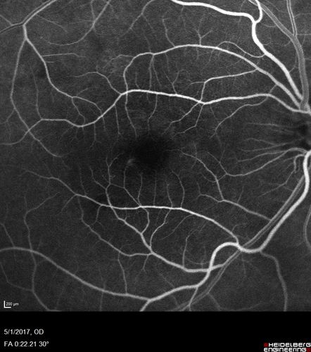 Central Serous Retinopathy - Subretinal Fibrin
66 year old female with 20 year history of single episode of CSR.  Now with vision loss for a month but improving - VA 20/63 OD; 20/32 OS
