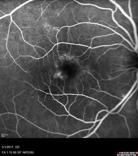 Central Serous Retinopathy - Subretinal Fibrin
66 year old female with 20 year history of single episode of CSR.  Now with vision loss for a month but improving - VA 20/63 OD; 20/32 OS
