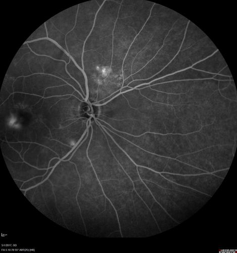Central Serous Retinopathy - Subretinal Fibrin
66 year old female with 20 year history of single episode of CSR.  Now with vision loss for a month but improving - VA 20/63 OD; 20/32 OS
