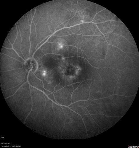 Central Serous Retinopathy - Subretinal Fibrin
66 year old female with 20 year history of single episode of CSR.  Now with vision loss for a month but improving - VA 20/63 OD; 20/32 OS
